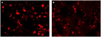 Anti-Kelch-like protein 11 antibody encephalitis: a case report and literature review